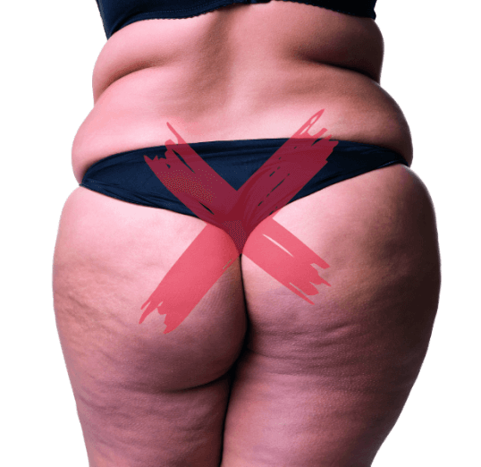 Cellulite