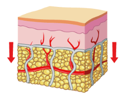 Cellulite après SLIMSTAR