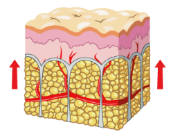 Cellulite avant SLIMSTAR